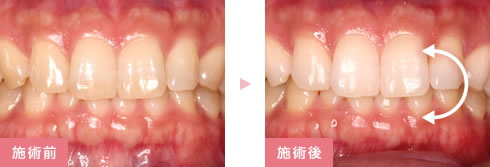 施術前後の比較写真1