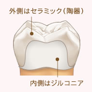 オールセラミッククラウン