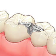メタルインレー