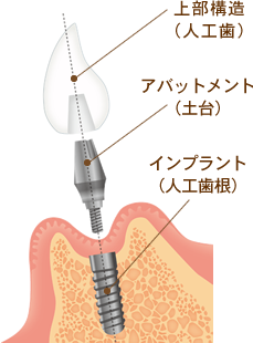 インプラントの構造